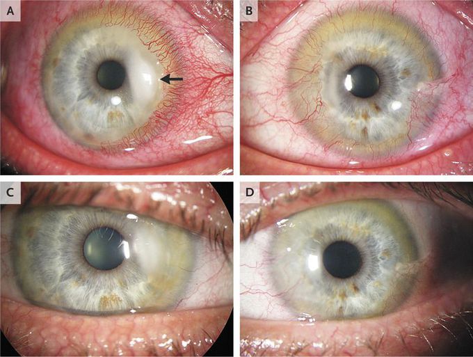 Ocular Rosacea