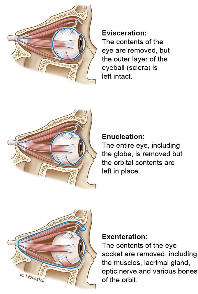 Surgeries for Removal of the Eye