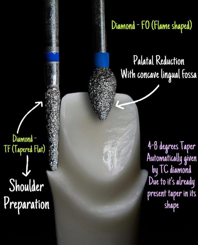 All-Ceramic Crown Tooth Preparation II