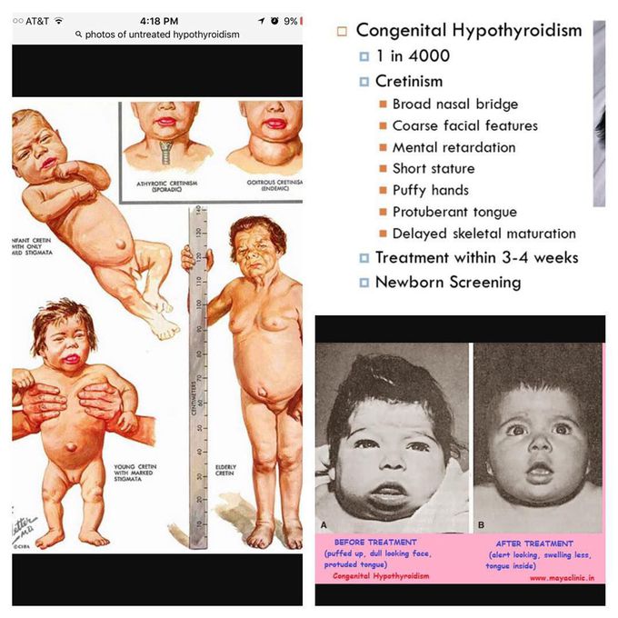 Congenital Hypertyroidism