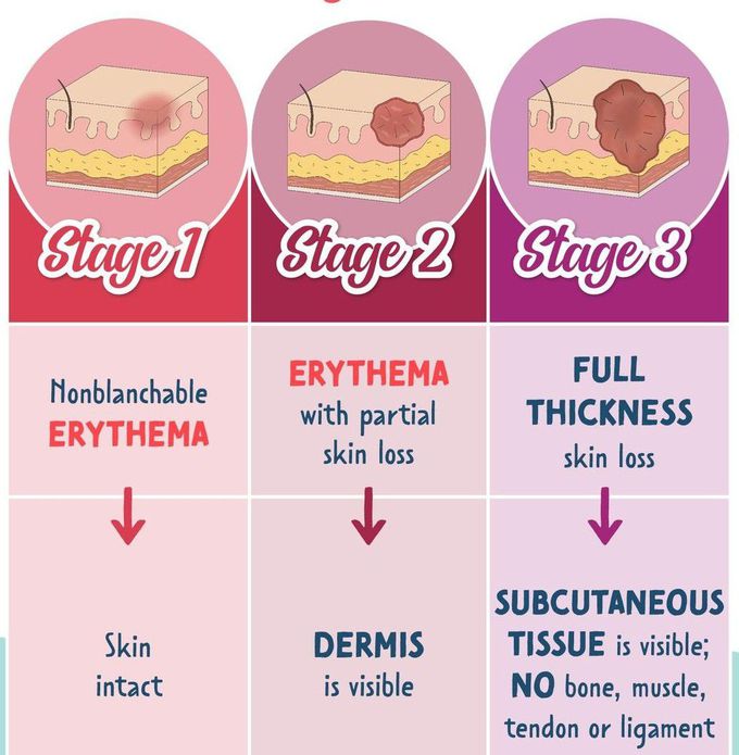 Pressure Injuries