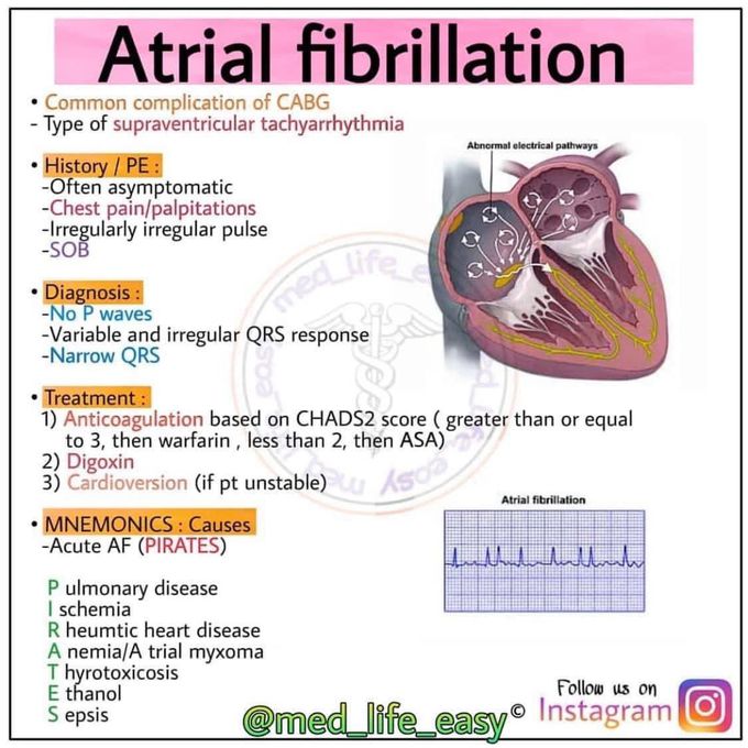 Atrial fibrillation