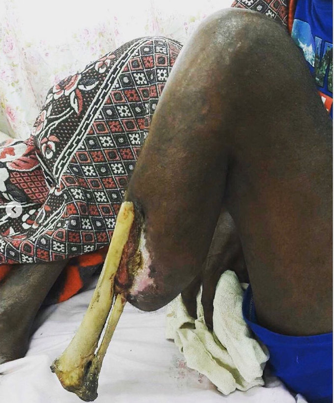 Gangrenous leg!!