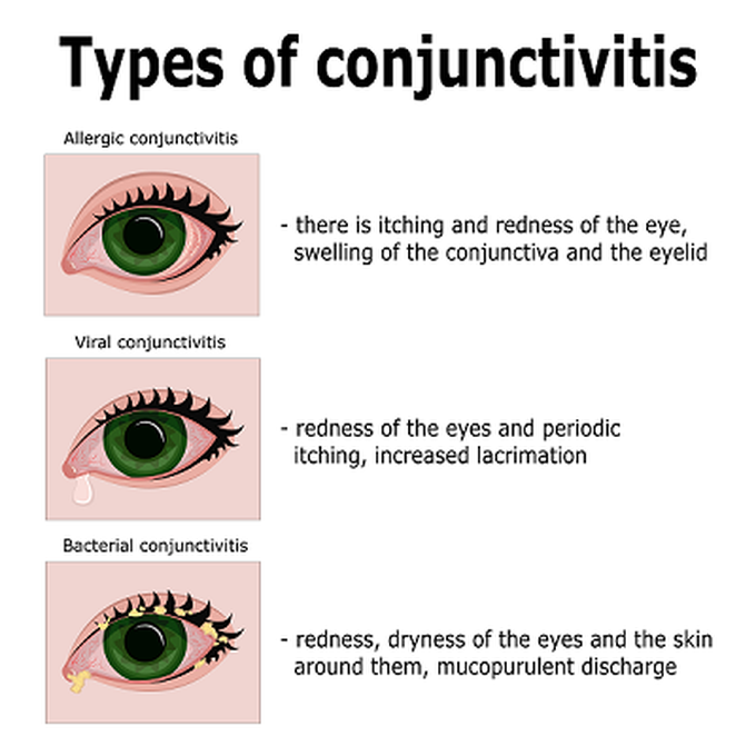 Conjunctivitis - MEDizzy