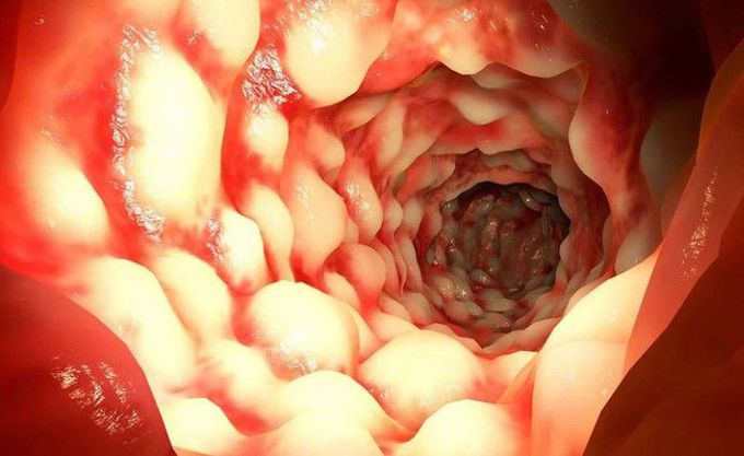 Crohn’s disease