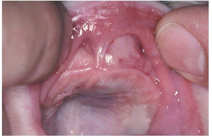 Melanotic Neuroectodermal Tumor of Infancy