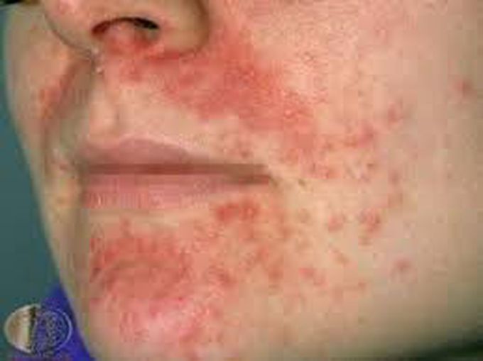 Treatment of perioral dermatitis