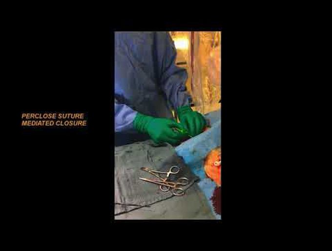 Perclose Suture Mediated Closure Technique