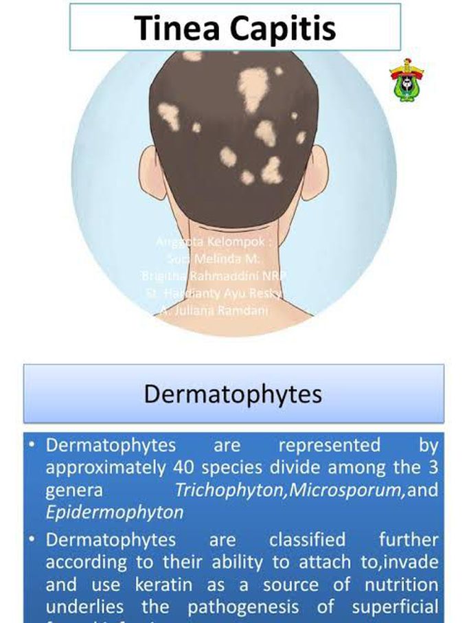 Tinea Capitis