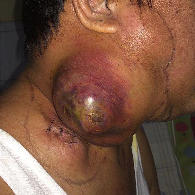 Tumor colli