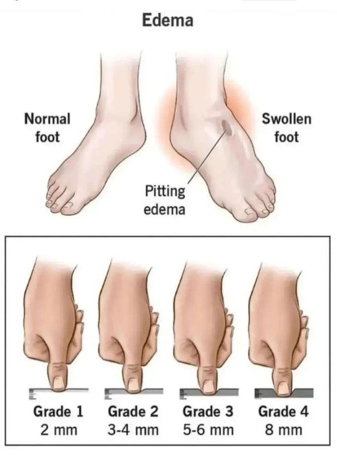 Edema