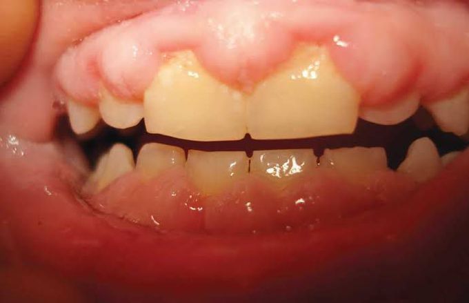 Gingival hyperplasia