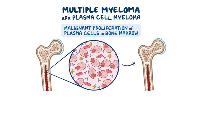 Multiple myeloma