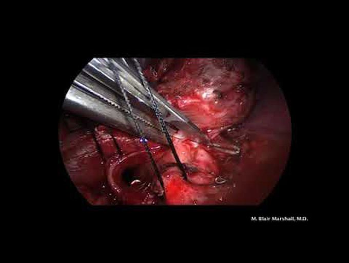 Video-Assisted Pediatric Left Upper Lobe Sleeve Lobectomy