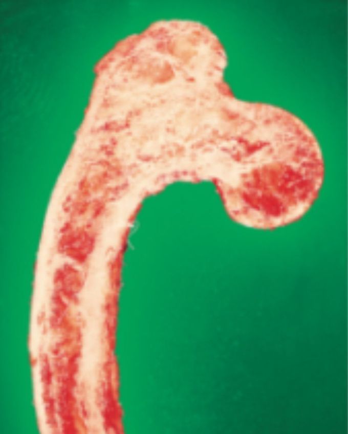 Complications in Paget disease