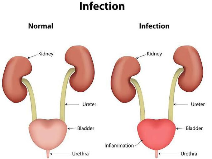 Treatment of UTI