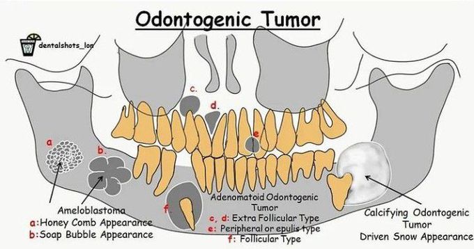 Odontogenic tumor