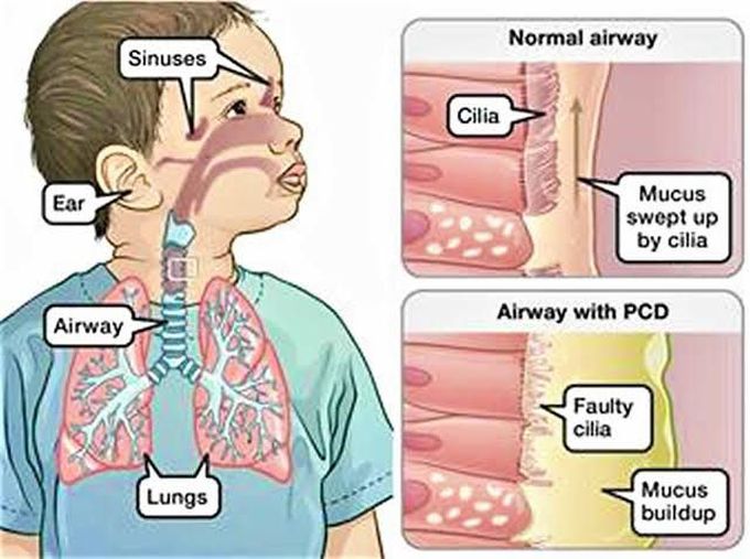 Kartagener syndrome caused