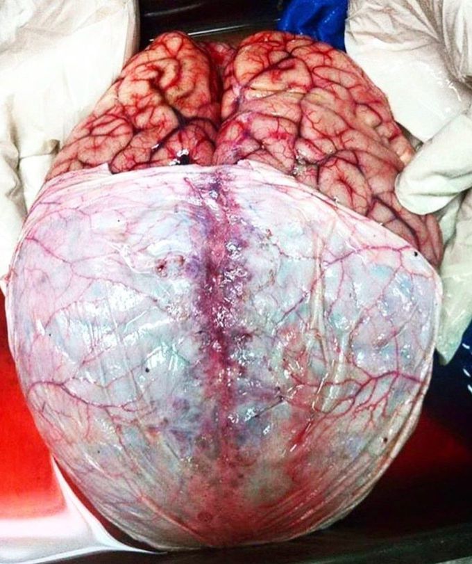A question directed at each brain surgeon Can the brain be removed from the head and operated like a heart?