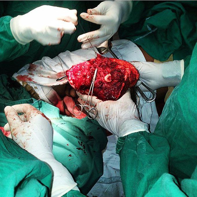 Leg amputation with a 'fish mouth' flap technique
