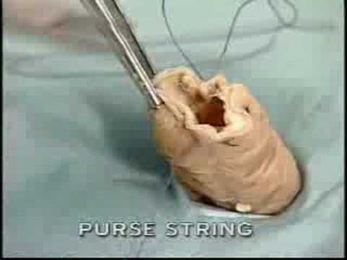 Purse String Sutures