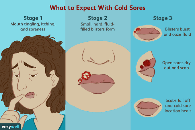 Stages of cold sores