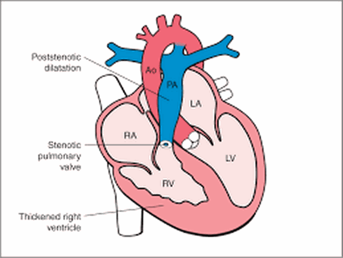 Infundibular stenosis