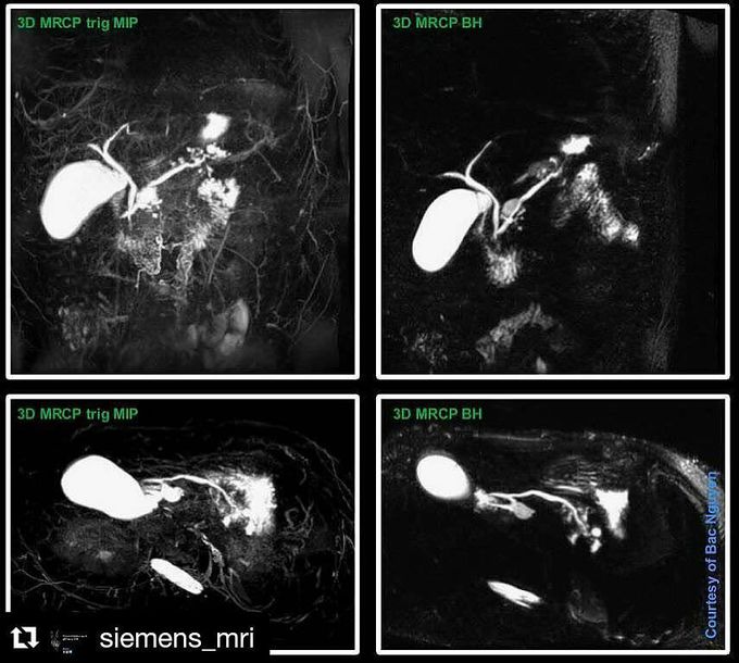 3D MRCP breath hold