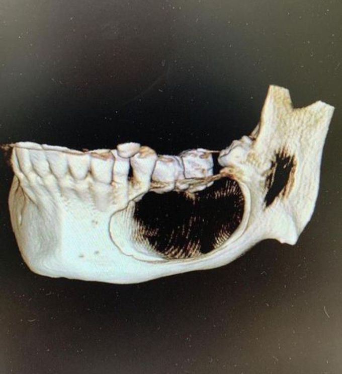 Unicystic Ameloblastoma MEDizzy