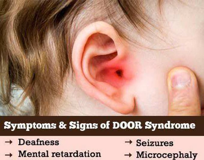 These are the symptoms of DOOR syndrome