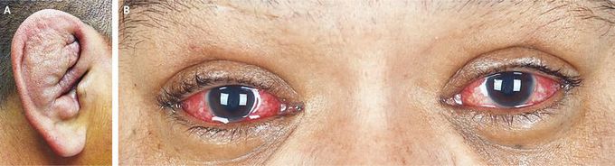 Polychondritis with Auricular and Ocular Involvement