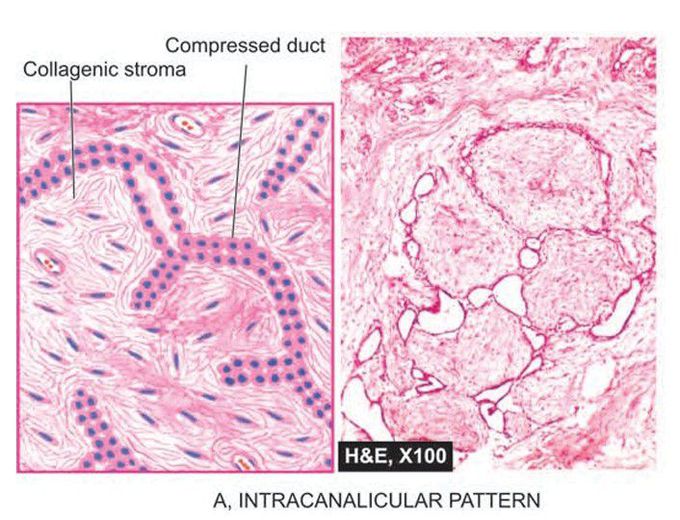 Fibroadenoma