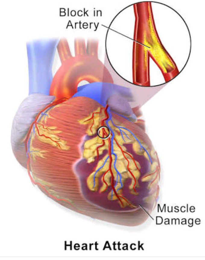 HEART ATTACK