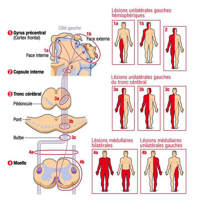 Left lesions of the corticobular and corticospinal tract(pyramidal);