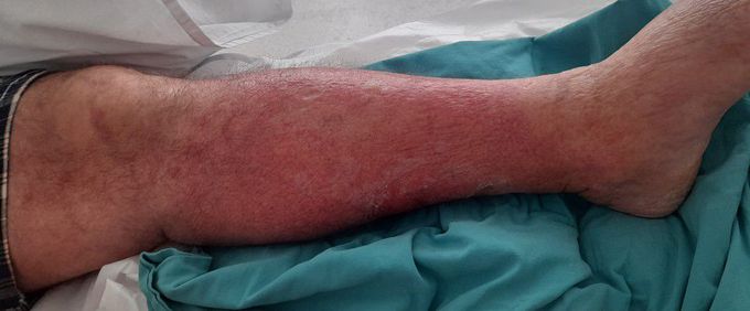 Cellulitis of the leg