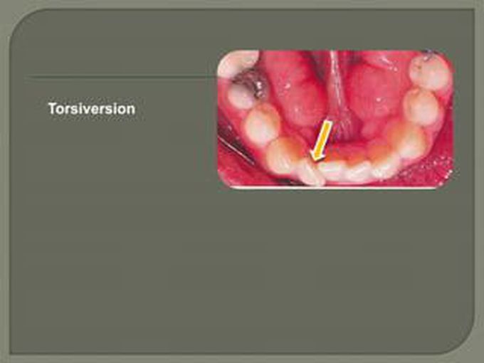 Torsiversion