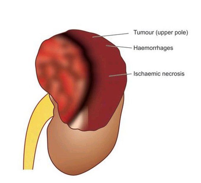 Renal cell carcinoma