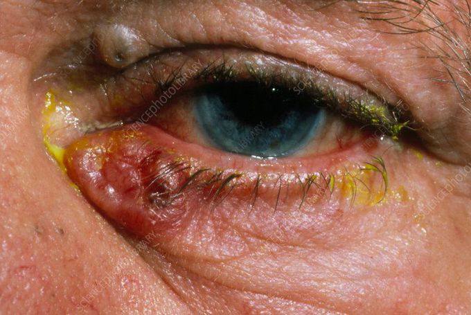 Basal Cell Carcinoma of the Eyelid