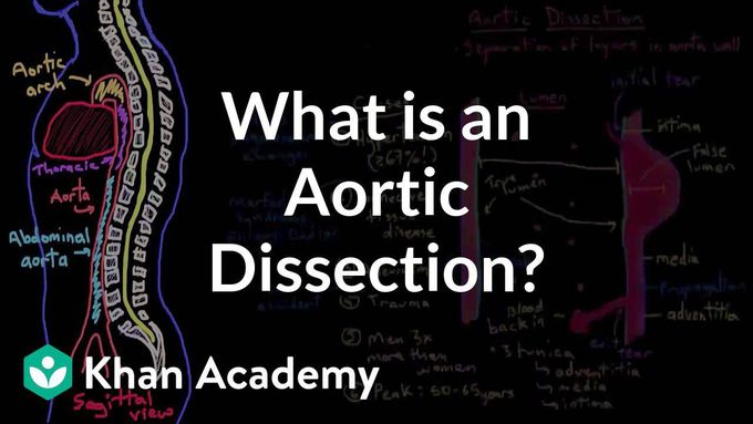 Aortic dissection-Explained