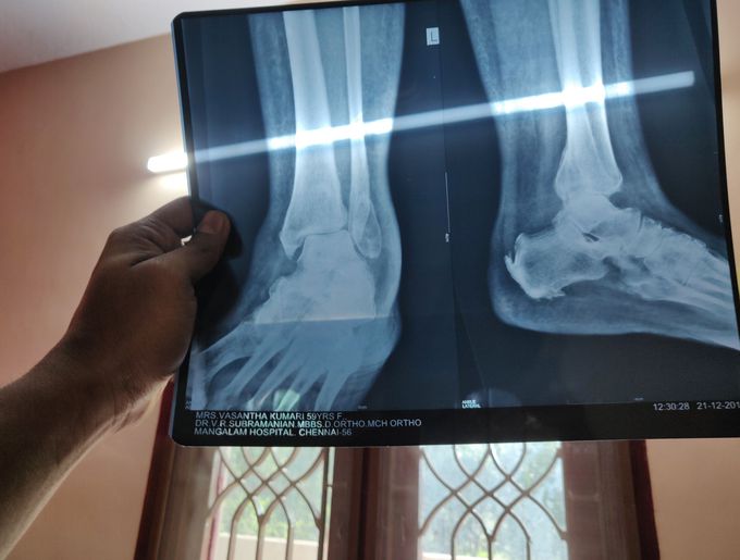 Plantar flexion