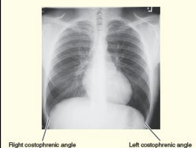 Costophrenic angle__normal lungs