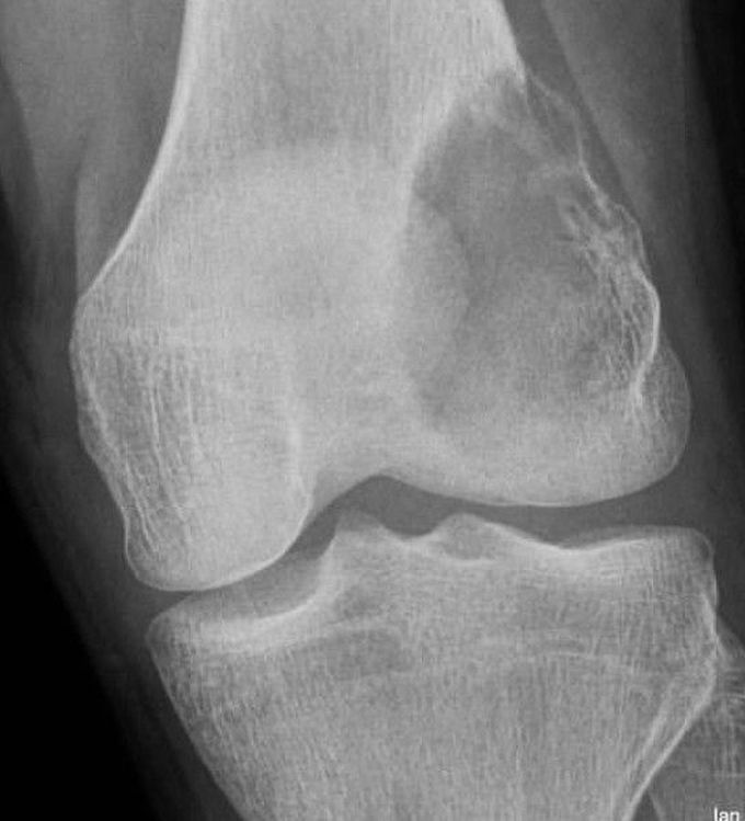 Lytic Metastasis due to Renal Cell Carcinoma