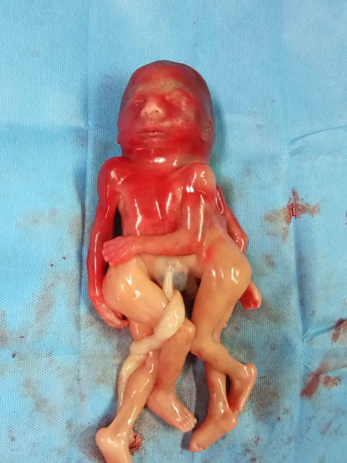 CephaloThoracopagus Conjoint Twins