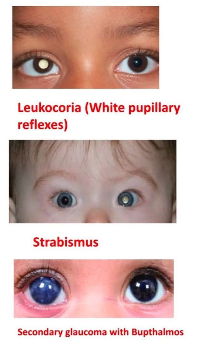 Retinoblastoma III