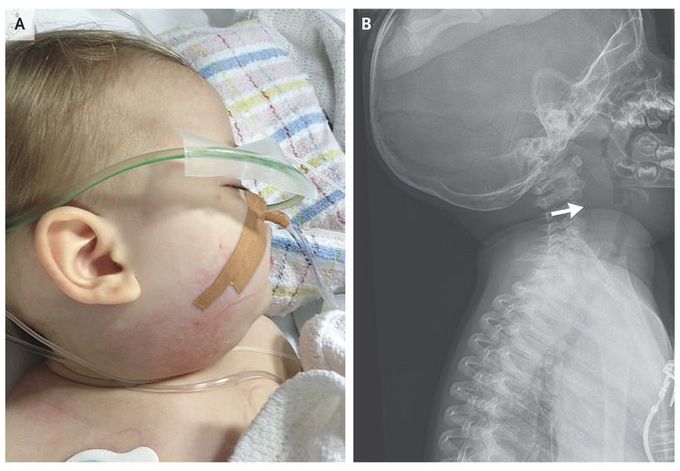 Acute Neck Infection