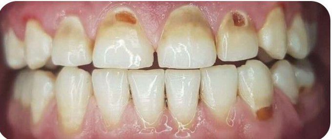 Dental erosion