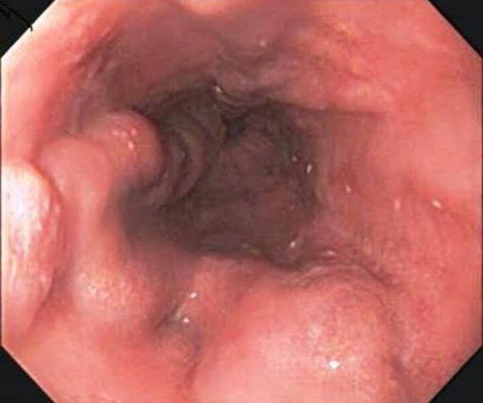 Esophageal Varices