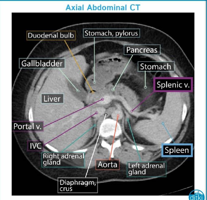 Axial Abdominal  CT