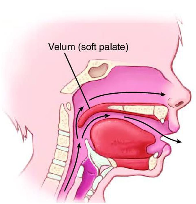 Velopharyngeal insufficiency