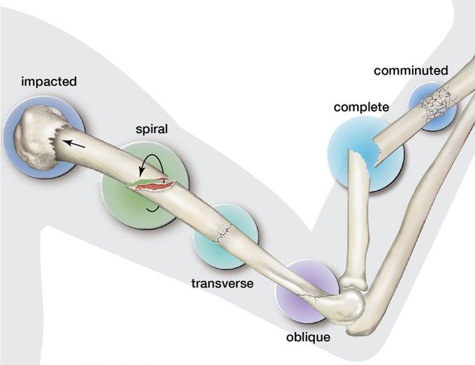 Types of Fracture